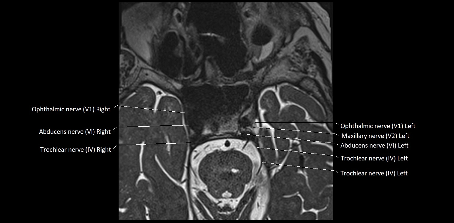 Cranial nerve anatomy axial MRI 3T image 35.webp